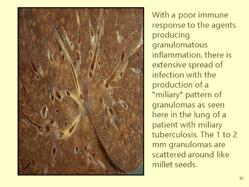 With a poor immune response to the agents producing granulomatous inflammation, there is extensive